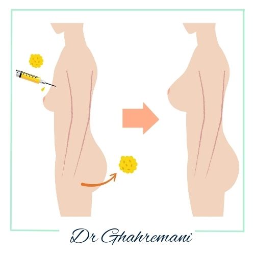 تزریق چربی به بدن