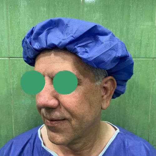 لیفت صورت لیفت صورت