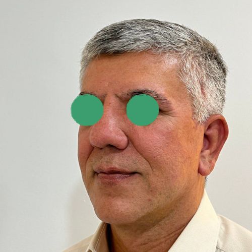 لیفت صورت لیفت صورت