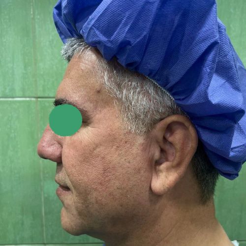 لیفت صورت لیفت صورت