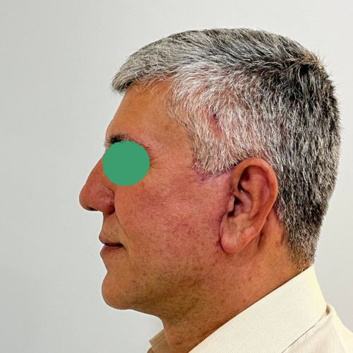 لیفت صورت لیفت صورت