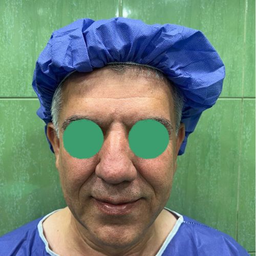 لیفت صورت لیفت صورت