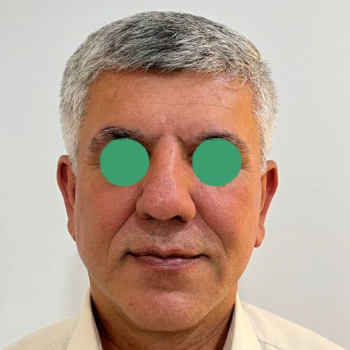 لیفت صورت لیفت صورت