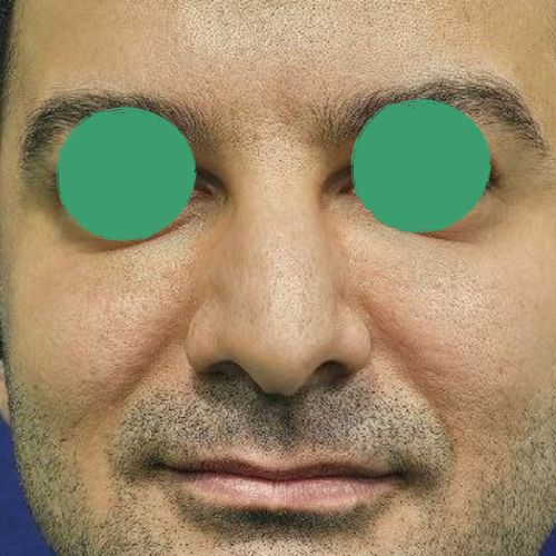 رینوپلاستی رینوپلاستی