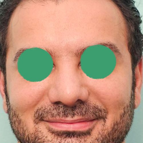 رینوپلاستی رینوپلاستی