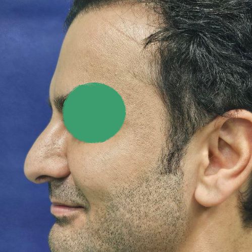 رینوپلاستی رینوپلاستی