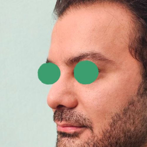 رینوپلاستی رینوپلاستی