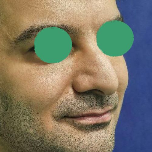 رینوپلاستی رینوپلاستی