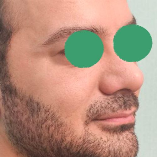 رینوپلاستی رینوپلاستی