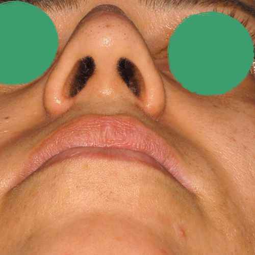 رینوپلاستی رینوپلاستی