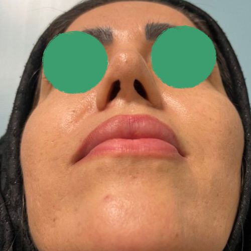 رینوپلاستی رینوپلاستی