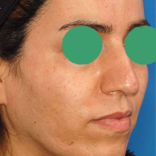 رینوپلاستی رینوپلاستی