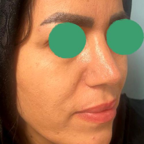 رینوپلاستی رینوپلاستی