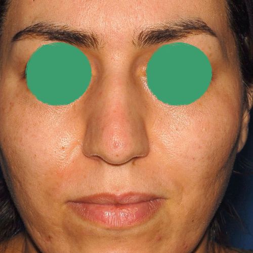 رینوپلاستی رینوپلاستی