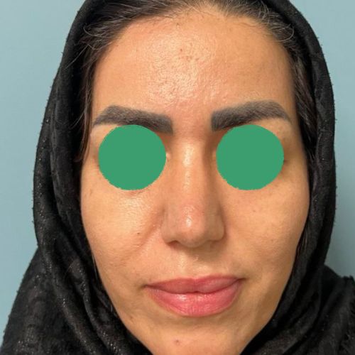 رینوپلاستی رینوپلاستی