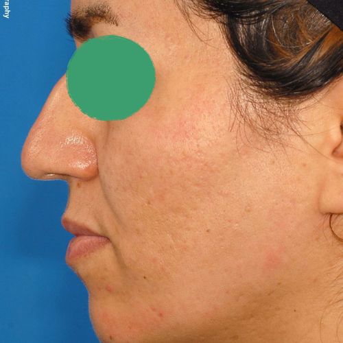 رینوپلاستی رینوپلاستی