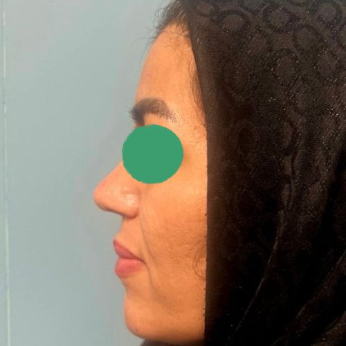 رینوپلاستی رینوپلاستی