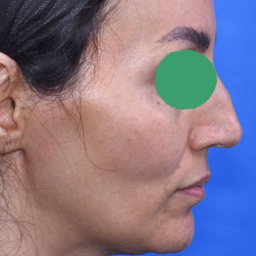 رینوپلاستی رینوپلاستی