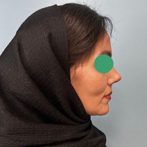 رینوپلاستی رینوپلاستی