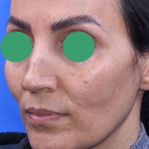 رینوپلاستی رینوپلاستی