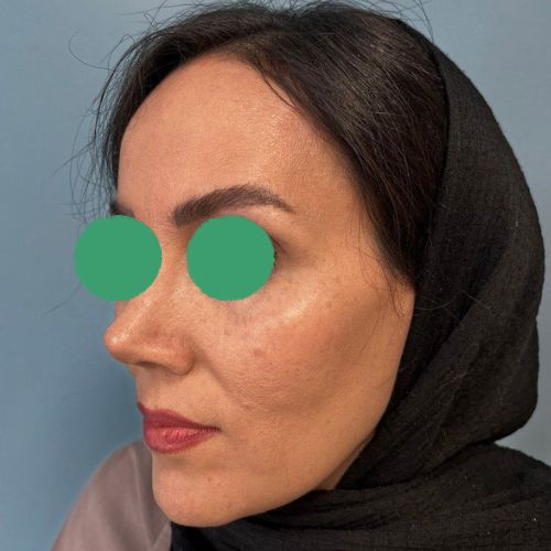 رینوپلاستی رینوپلاستی