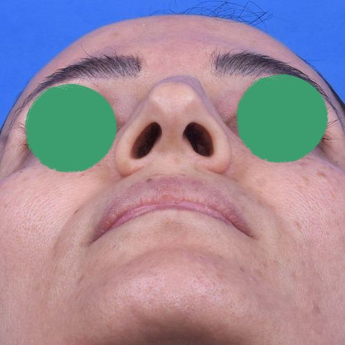 رینوپلاستی رینوپلاستی