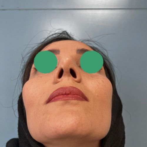 رینوپلاستی رینوپلاستی