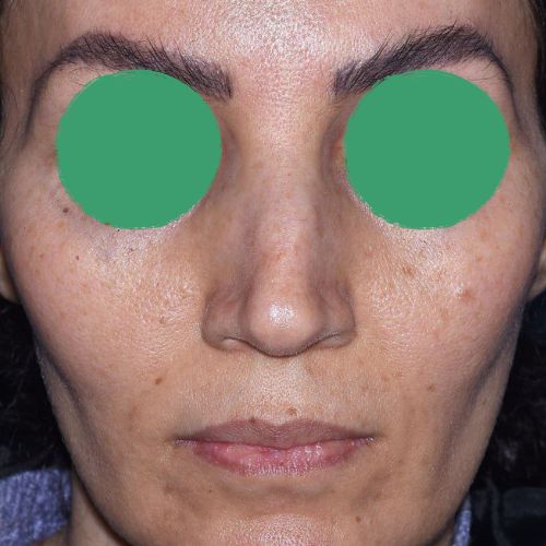 رینوپلاستی رینوپلاستی