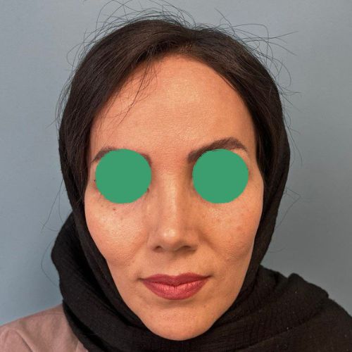 رینوپلاستی رینوپلاستی