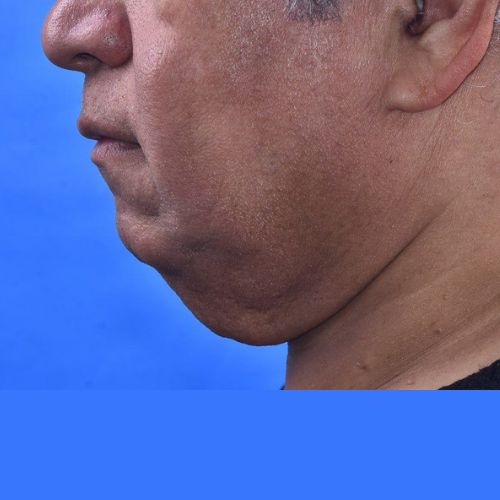 عمل غبغب عمل غبغب