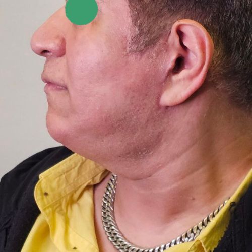 عمل غبغب عمل غبغب