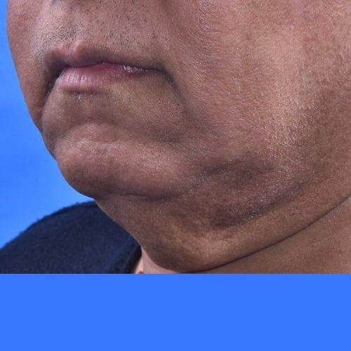 عمل غبغب عمل غبغب