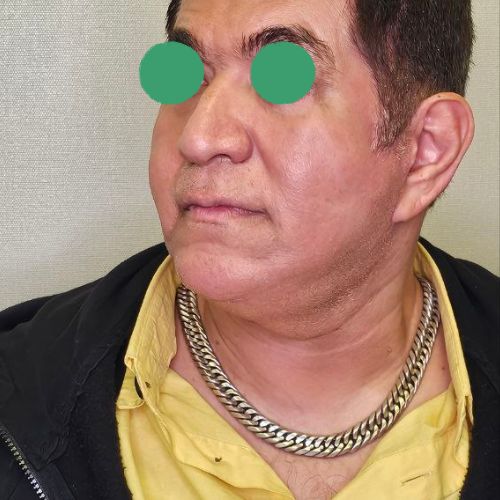 عمل غبغب عمل غبغب