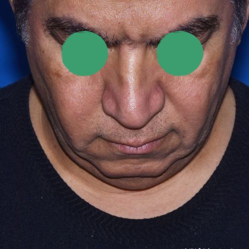 عمل غبغب عمل غبغب