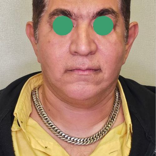 عمل غبغب عمل غبغب