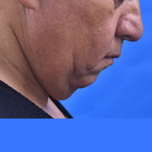 عمل غبغب عمل غبغب