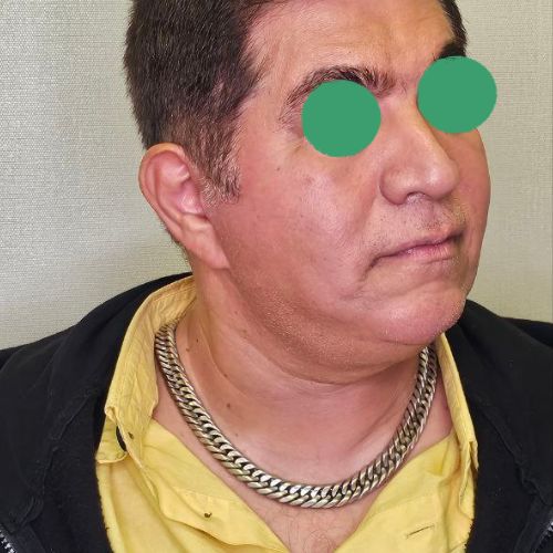 عمل غبغب عمل غبغب