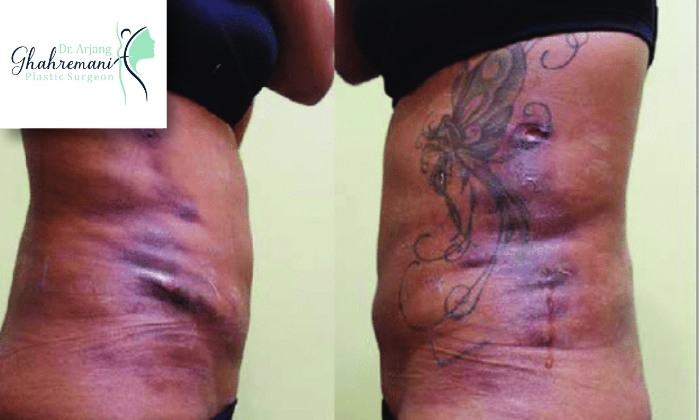 علائم عفونت بعد از لیپوساکشن