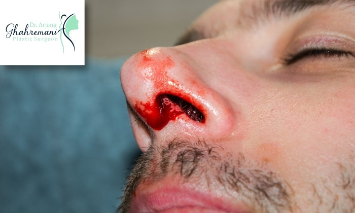 علائم نیاز به جراحی در شکستگی بینی علائم نیاز به جراحی در شکستگی بینی