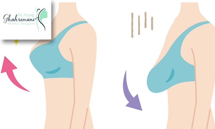 علل تغییر فرم سینه‌ها پس از تغییرات وزن یا بارداری