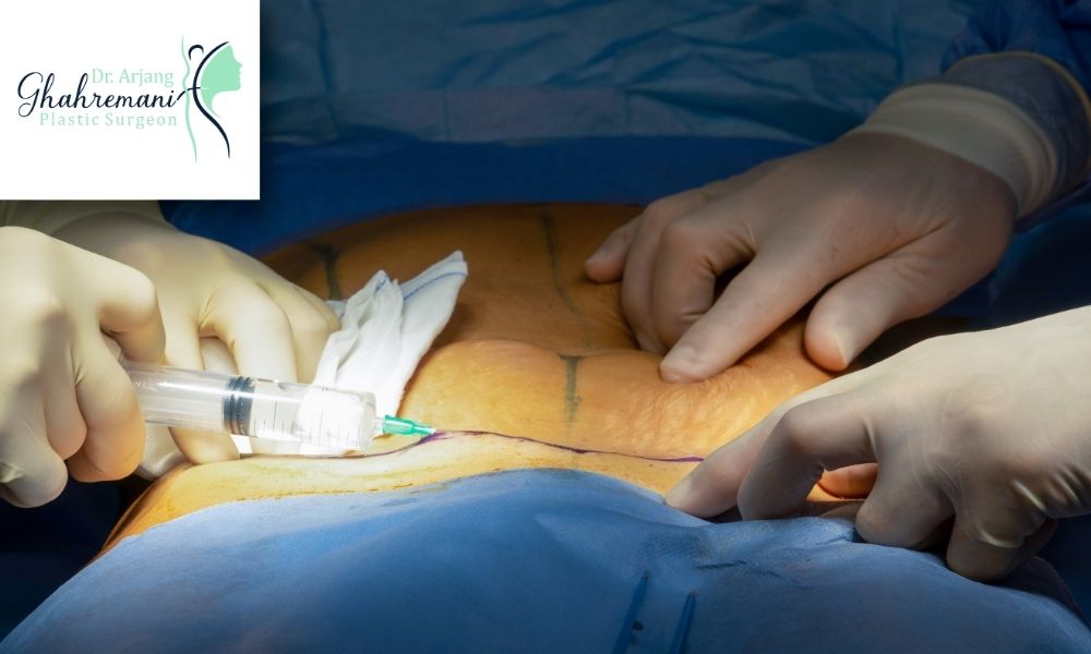 عوارض عمل ابدومینوپلاستی