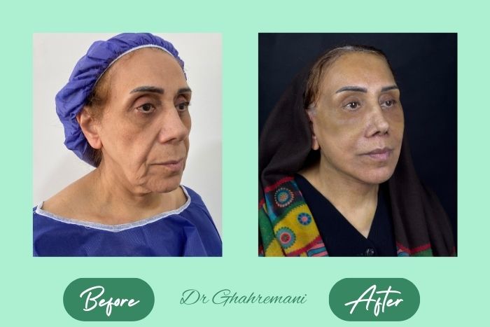 سوپر لیفت کامل صورت و گردن سوپر لیفت کامل صورت و گردن