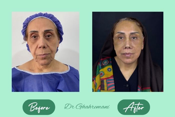 سوپر لیفت کامل صورت و گردن سوپر لیفت کامل صورت و گردن