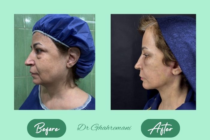 سوپر لیفت کامل صورت و گردن سوپر لیفت کامل صورت و گردن