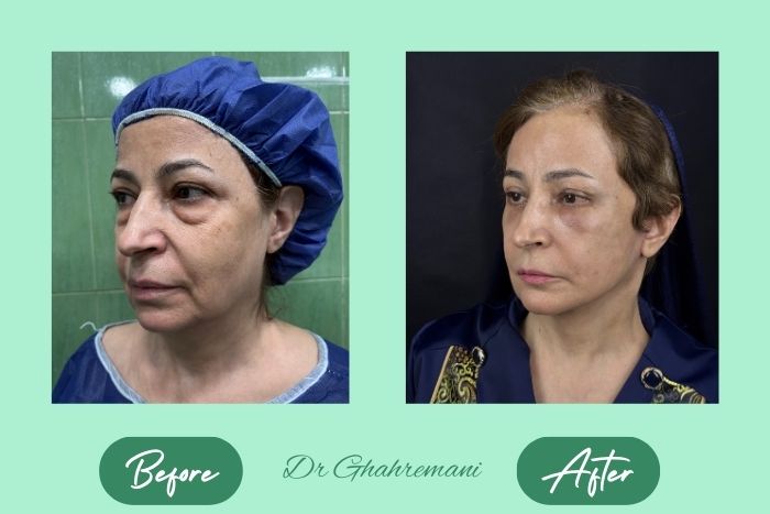 سوپر لیفت کامل صورت و گردن سوپر لیفت کامل صورت و گردن