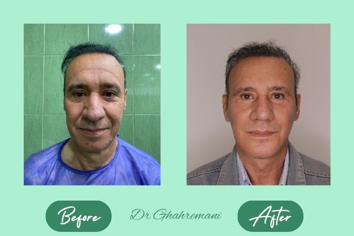 سوپر لیفت کامل صورت و گردن سوپر لیفت کامل صورت و گردن