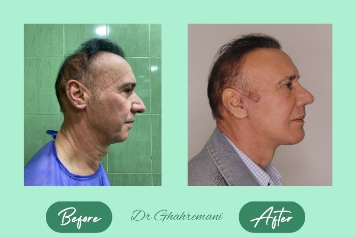 سوپر لیفت کامل صورت و گردن سوپر لیفت کامل صورت و گردن