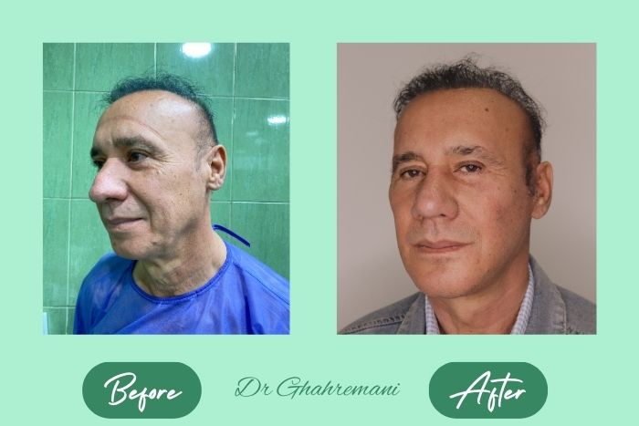 سوپر لیفت کامل صورت و گردن سوپر لیفت کامل صورت و گردن