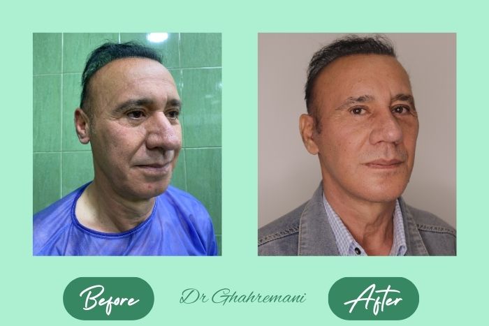 سوپر لیفت کامل صورت و گردن سوپر لیفت کامل صورت و گردن