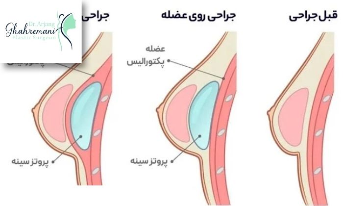 تفاوت های پروتز پستان زیر عضله و روی عضله تفاوت های پروتز پستان زیر عضله و روی عضله